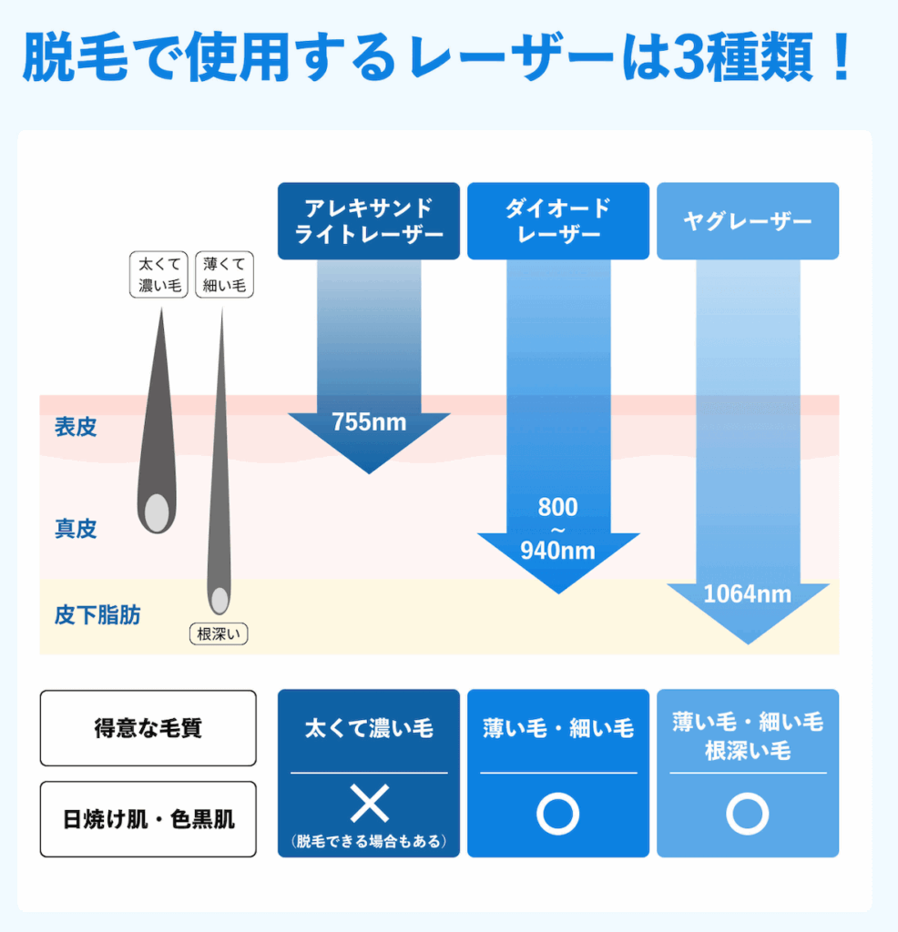 メンズ脱毛_レーザーの種類