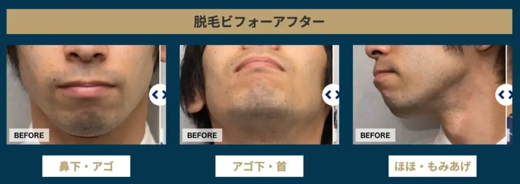 メンズ脱毛_ゴリラクリニック_ヒゲ症例A
