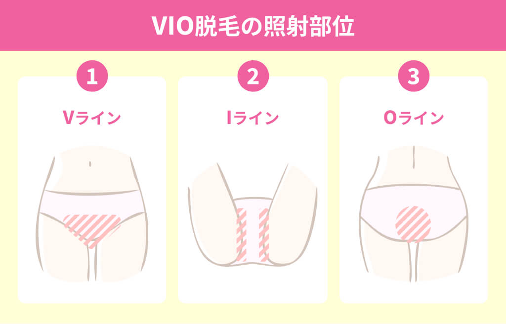 VIO脱毛の照射部位